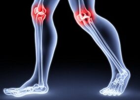 The causes of the development of knee arthrosis