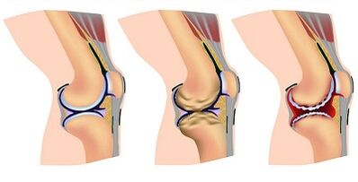 Stages of development of knee arthrosis joint