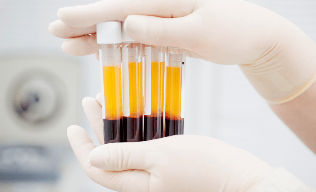 Platelet-rich plasma for PRP therapy in osteoarthritis